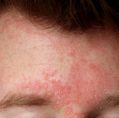 Avaderma Skin & Hair Clinic - Acne Vulgaris